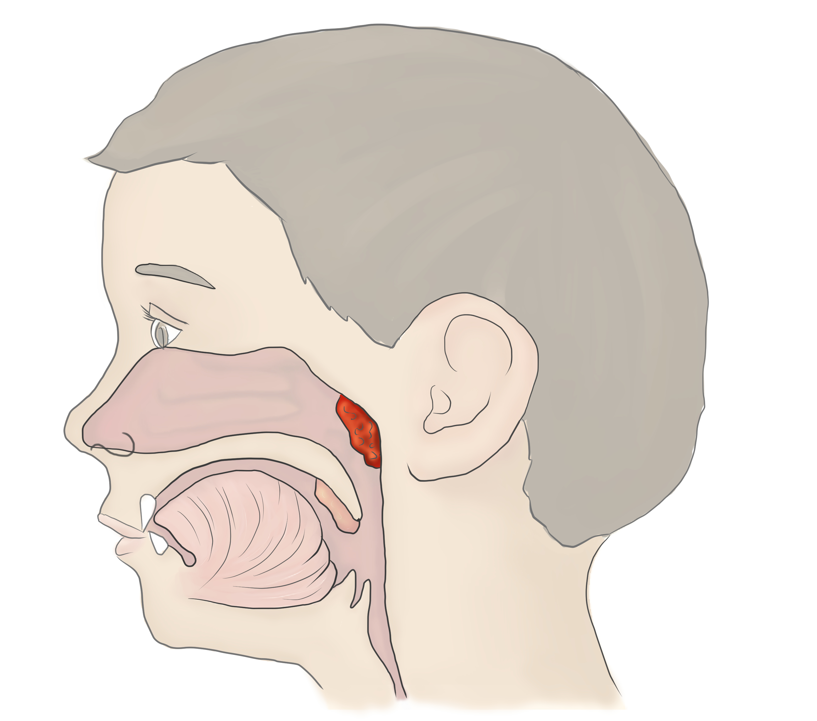 Заложенность носа боль в горле кашель. Аденоиды носоглоточные миндалины. Носоглотка воспаление аденоиды. Анатомия носоглотки аденоиды. Что такое аденоиды в носоглотке у ребенка.