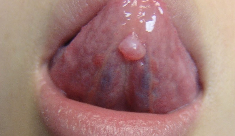 Слизистая киста под языком