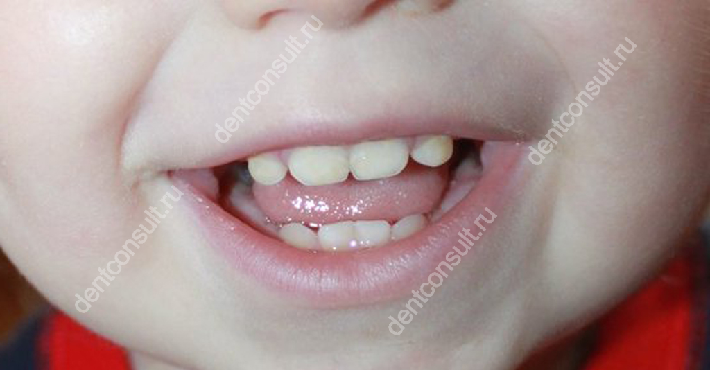 На фото показаны зубы ребенка в возрасте 1 года