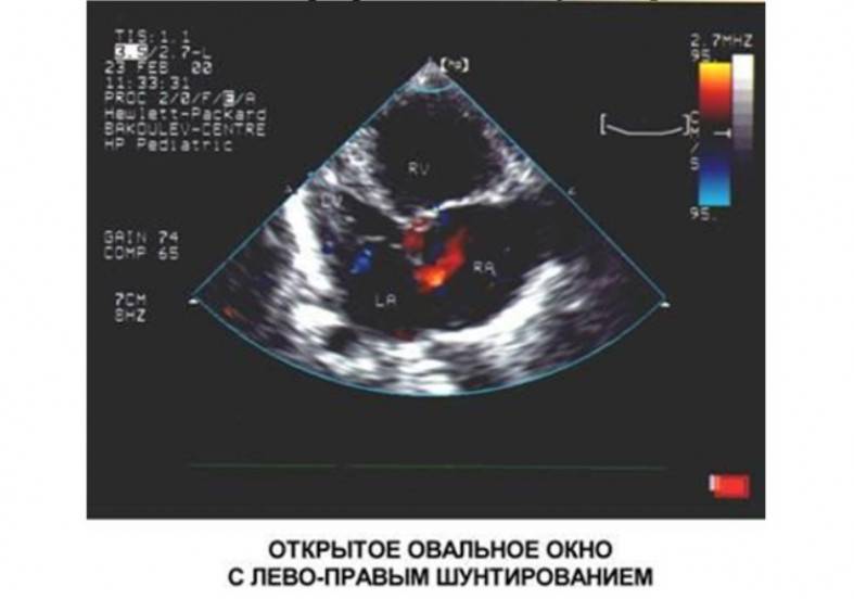 1 3 окно в сердце. Открытое овальное окно эхокардиография. УЗИ сердца открытое овальное окно у грудничка. Открытое овальное окошко у новорожденного. Открытое овальное окно в сердце у новорожденного 2мм.