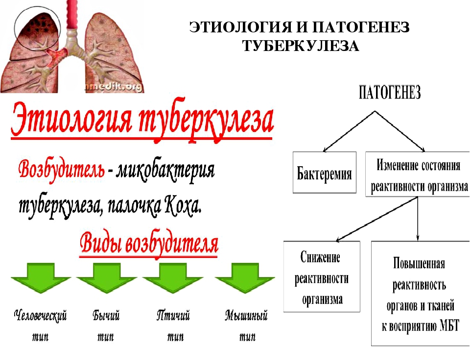 Туберкулезной этиологии