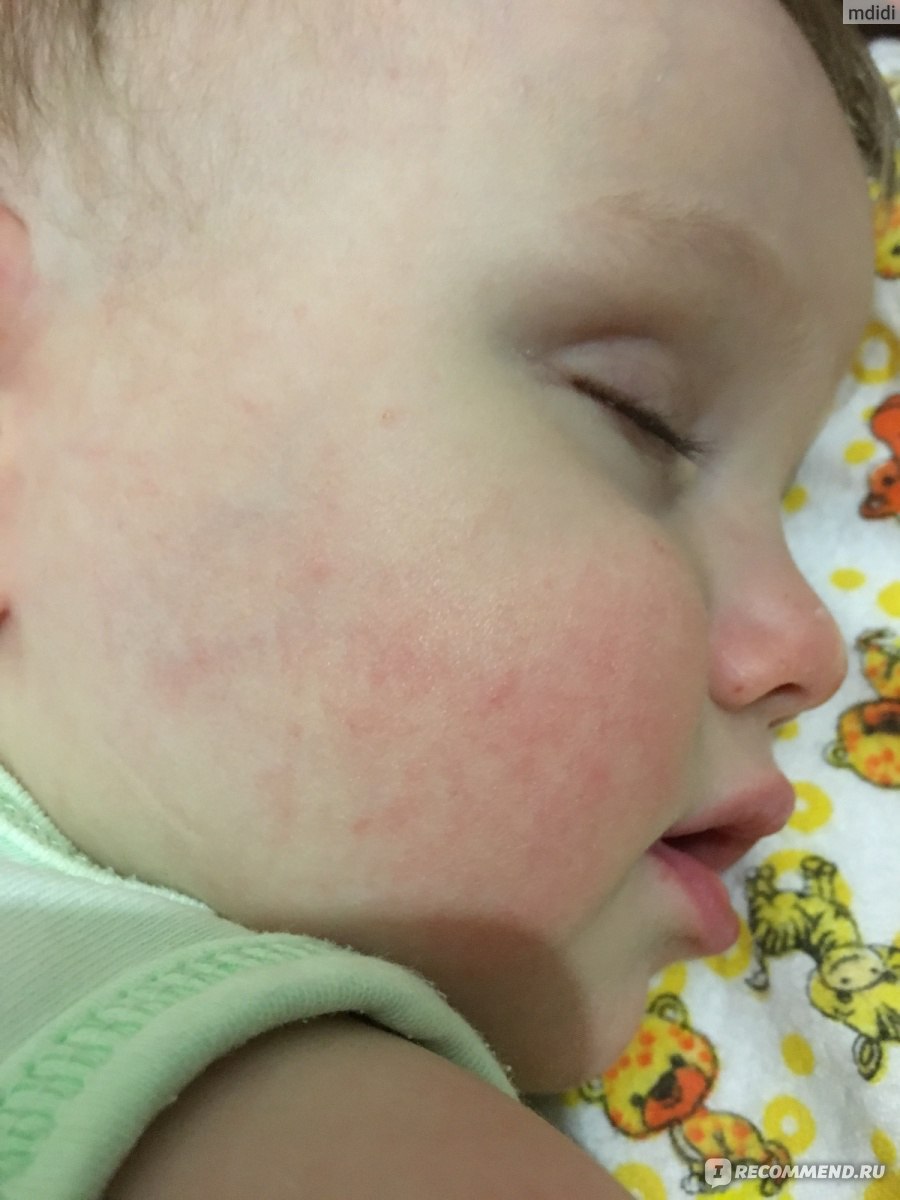 Аллергия на овсянку у новорожденных
