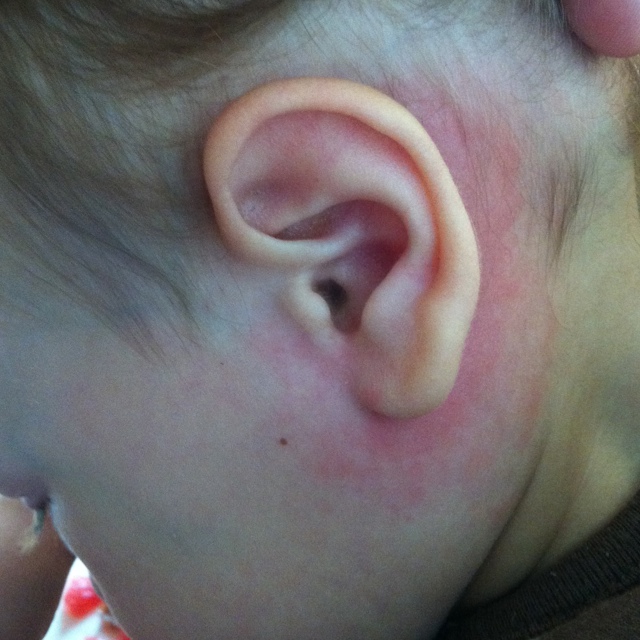 Покраснение за ухом у ребенка