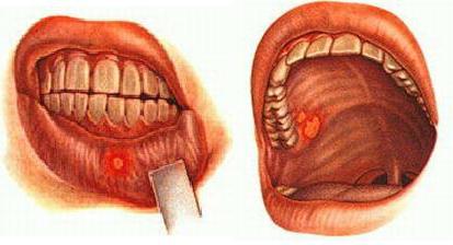 заболевания полости рта фото