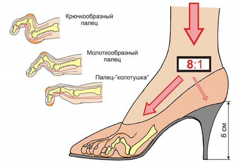 Ношу обувь на размер меньше. Деформация ноги от каблуков. Последствия высоких каблуков. Последствия ношения каблуков. Плоскостопие от каблуков.