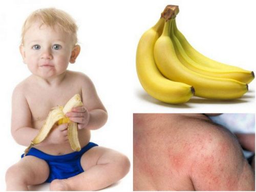 Аллергия на бананы у ребенка