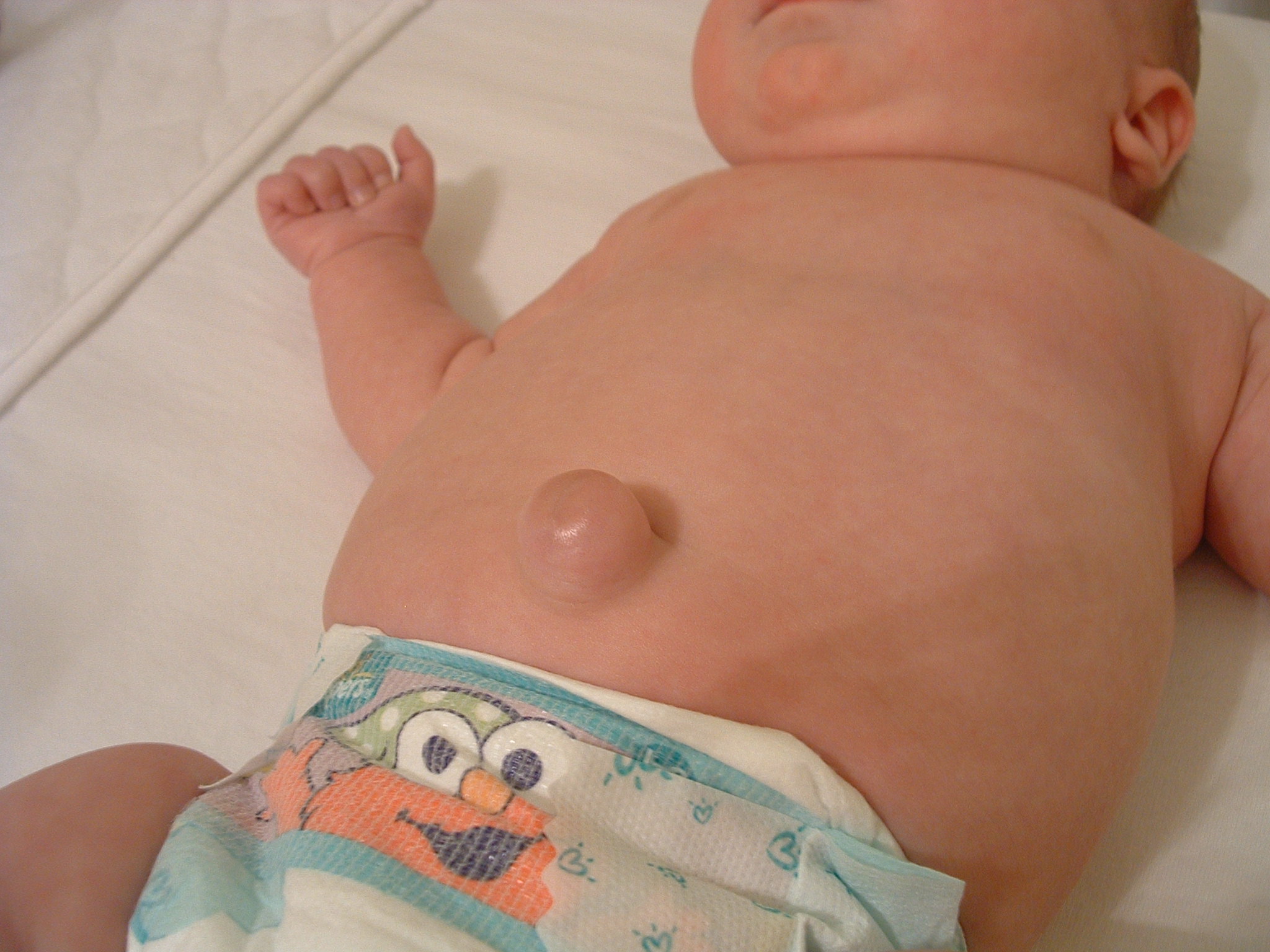 у новорожденного припухла одна грудь фото 12