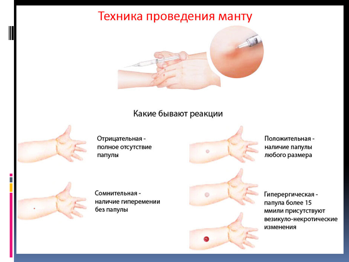 Сколько нельзя манту. Положительная реакция манту у ребенка 1 года. Реакция манту у детей ее нормы. Как выглядит нормальная реакция манту. Как выглядит положительная реакция манту у ребенка 1 год.