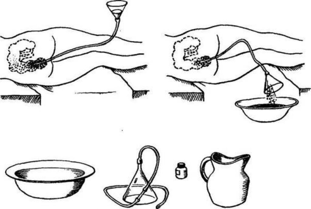 Картинки как ставить клизму