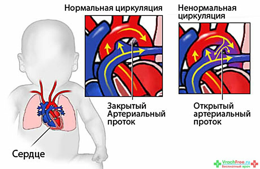 Порог сердца что это. Открытый артериальный проток рентген. Признаки порока сердца у грудничка. Симптомы врожденного порока сердца у новорожденного ребенка. Открытый артериальный проток рентген признаки.