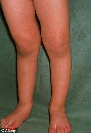New figures from the NHS show there were 833 hospital admissions for children suffering from rickets
