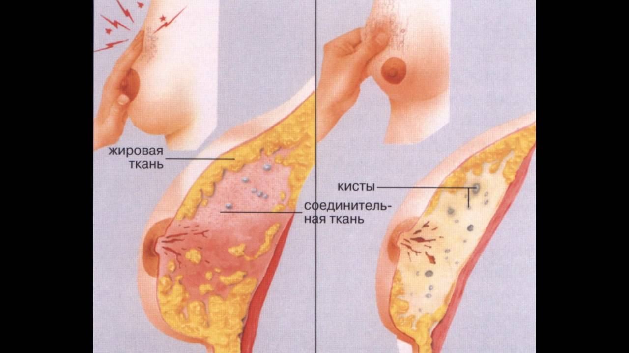 Лактационный мастит картинки