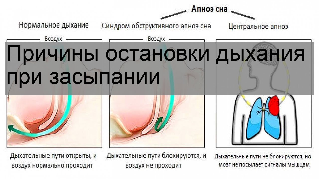 Задыхаюсь во сне. Остановка дыхания. Остановка дыхания при засыпании причины и лечение. Остановка дыхания во сне у взрослых причины. Почему остановка дыхания.