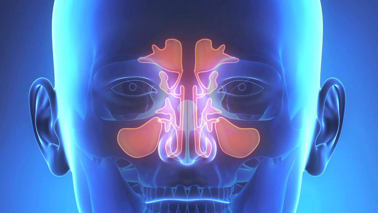 Синусит. Воспаление носовых пазух. Воспалительные заболевания околоносовых пазух.
