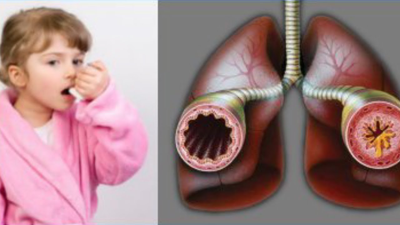 Бронхиальная астма бронхоспазм