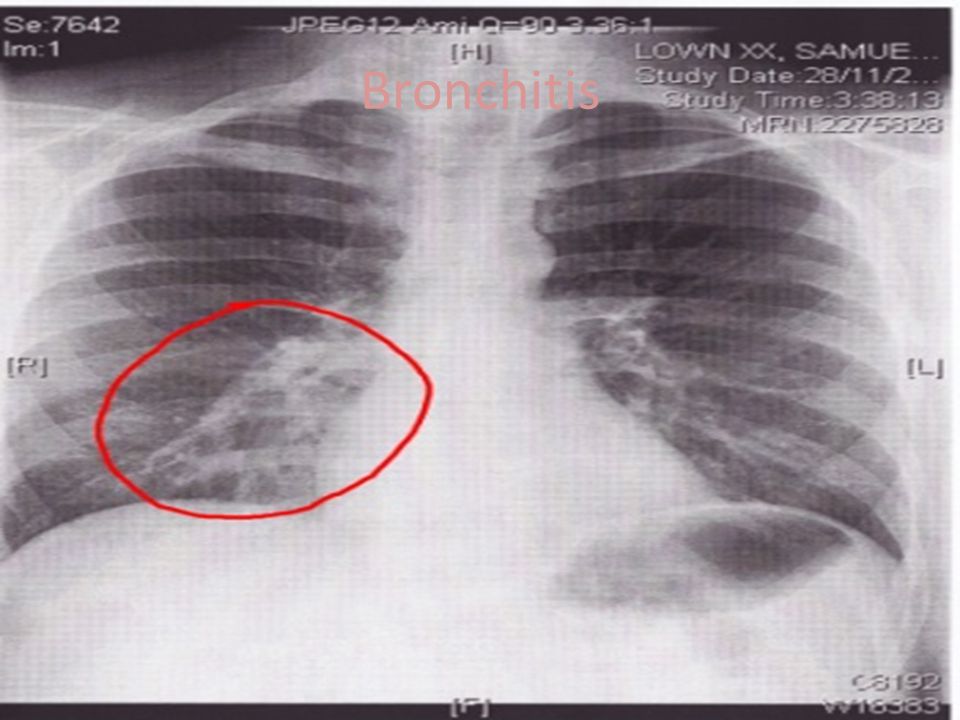 Можно ли на снимке. Рентгенография грудной клетки бронхит. Рентген при остром обструктивном бронхите. Острый обструктивный бронхит рентген. Рентгенография легких при хроническом бронхите.