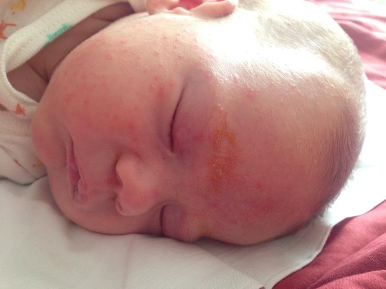 Аллергия на лбу у младенца