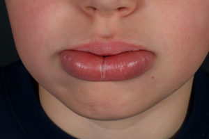 Лечение трещины на губе