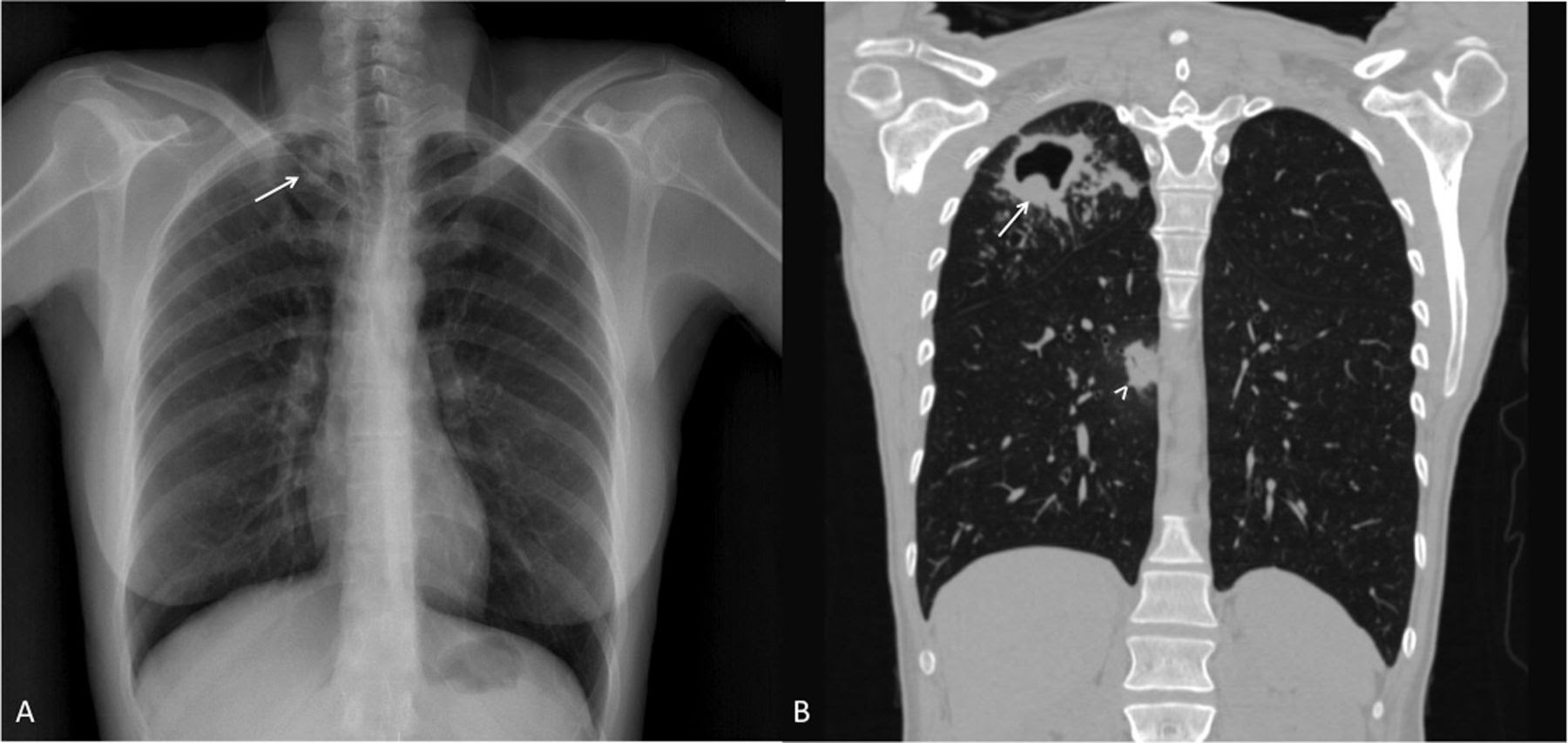 Разметка патологий на снимках. Сколько раз в год можно делать рентген. Tuberculosis diagnosis. Сколько раз можно делать рентген легких.