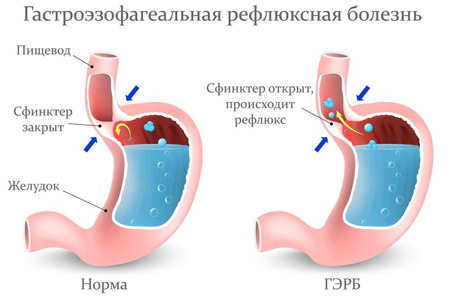 Околоминдальный абсцесс