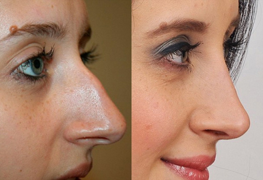 Ринопластика больших носов. Ринопластика горбинки носа. Нос с горбинкой после ринопластики. Нос с горбинкой до и после операции. Нос картошкой с горбинкой.