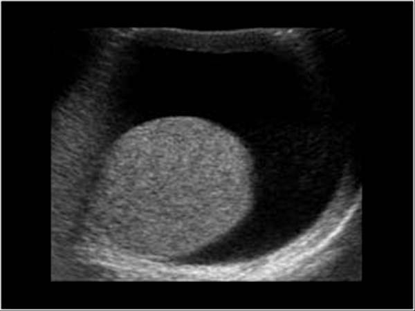Гипоплазия яичек у мужчин. Водянка оболочек яичка УЗИ.