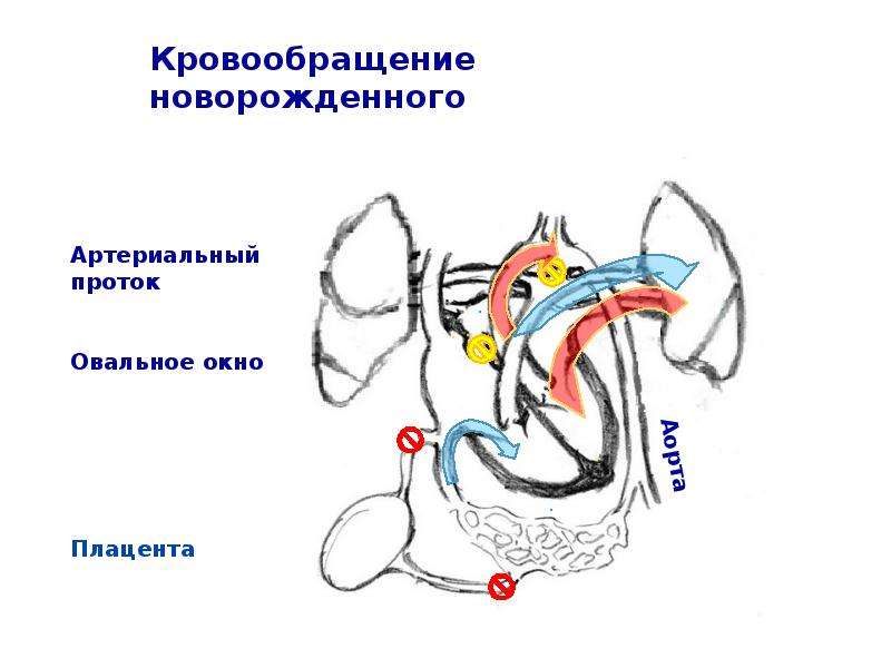 Открытое овальное окно у новорожденных