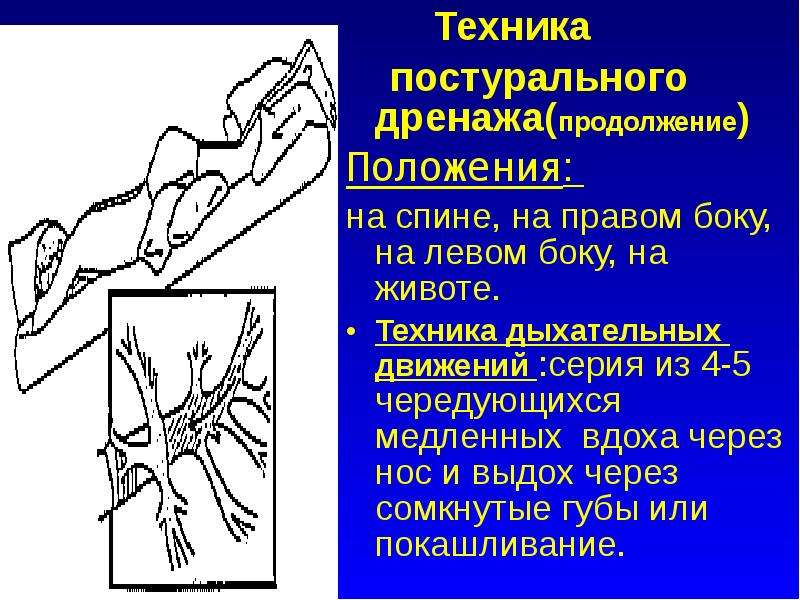 Постуральный дренаж. Постуральный дренаж бронхов. Позиционный дренаж бронхов. Проведение постурального дренажа бронхов. Позиционный (Постуральный) дренаж.