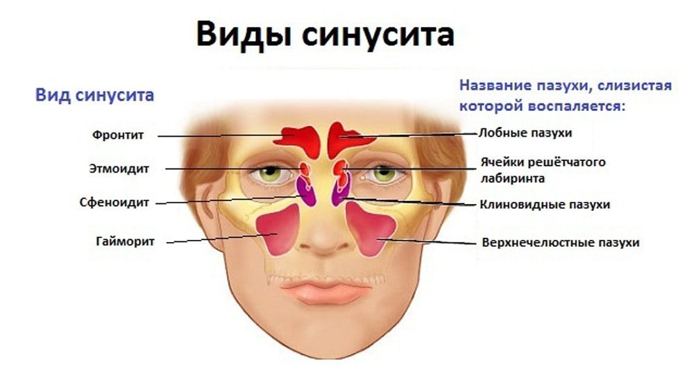 Гайморит пазухи. Таблица гайморит фронтит симптомы. Верхнечелюстной синусит , катаральный гайморит. Гайморит фронтит этмоидит. Острый этмоидальный синусит у взрослых.