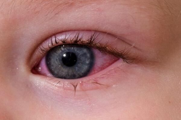 Покраснение глаза при аллергии