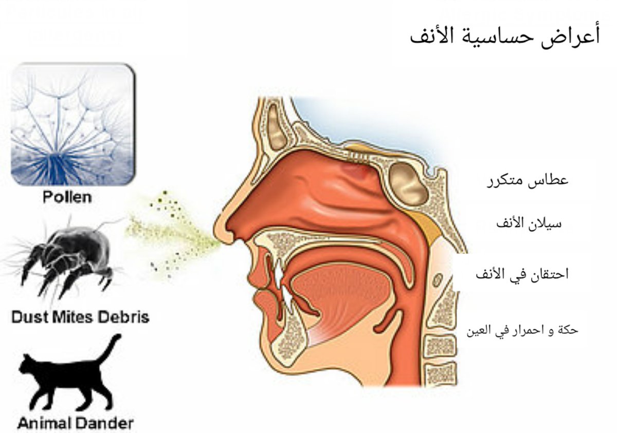 Сильное течение из носа. Аллергический ринит в носу. Аллергик ринит.