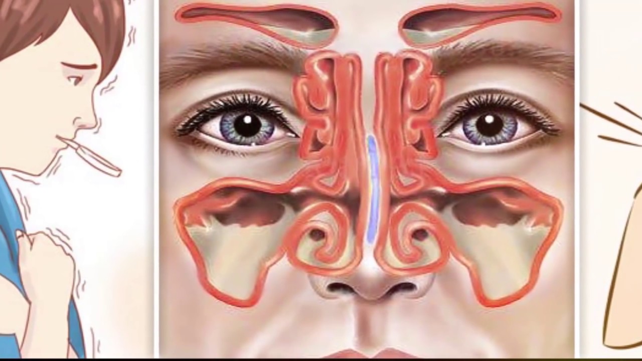 Хроническая заложенность носа у взрослых. Острый катаральный синусит. Катаральный верхнечелюстной синусит. Вазомоторный ринит риноскопия.