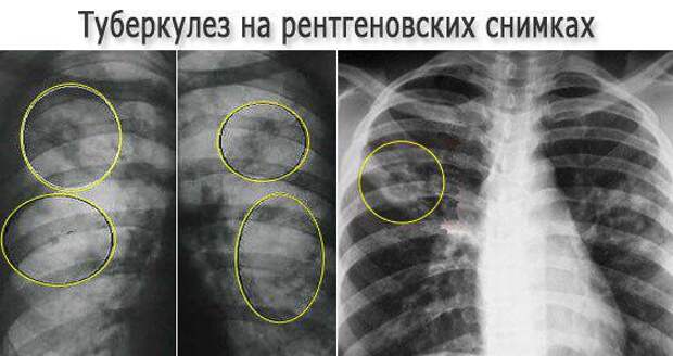 Легкие человека с туберкулезом. Туберкулез и пневмония на рентгене. Туберкулез легких рентген. Туберкулёзмлегкие на рентгене. Туберкулез рентген снимки.