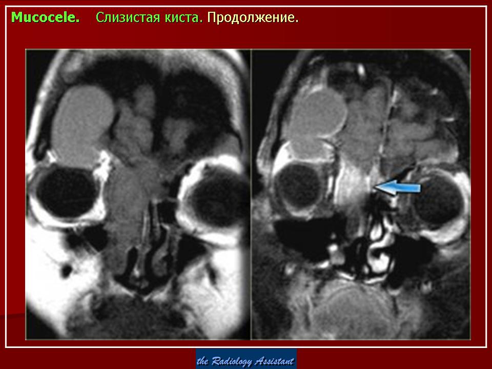 Мукоцеле синуса. Мукоцеле носового синуса кт. Мукоцеле гайморовой пазухи кт. Мукоцеле носового синуса мрт. Мукоцеле верхнечелюстной пазухи кт.
