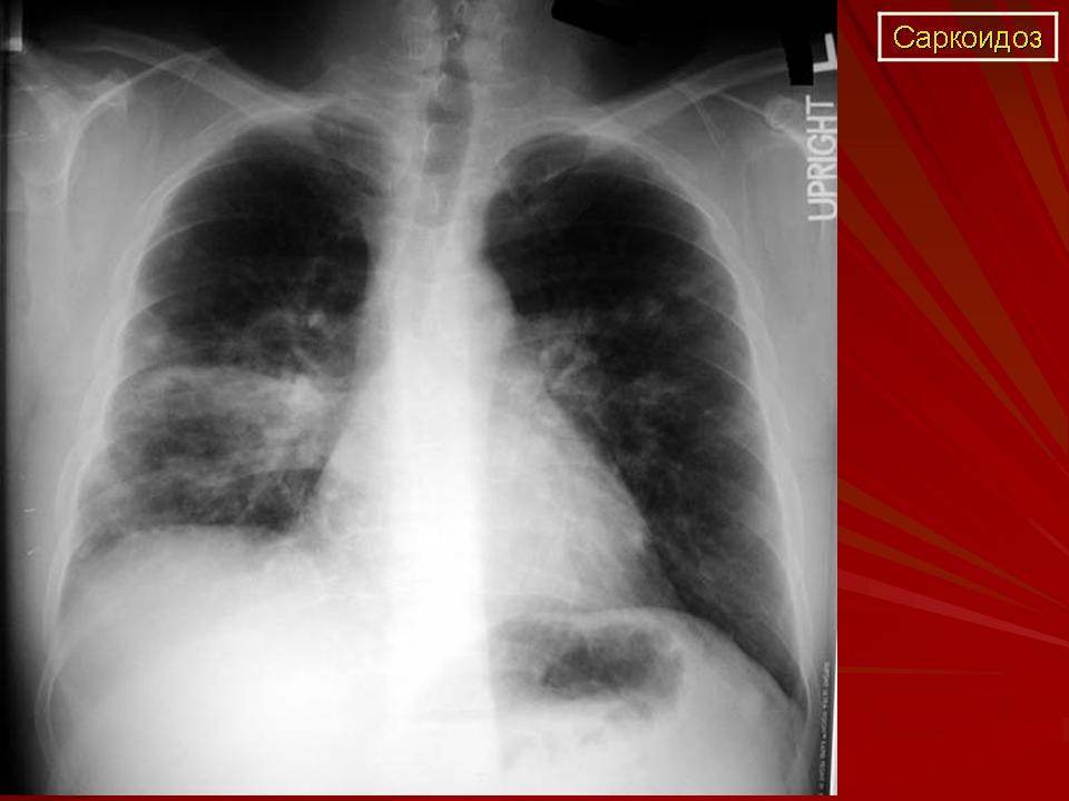 Саркоидоз. Кольцевидный саркоидоз. Легочная форма саркоидоза.