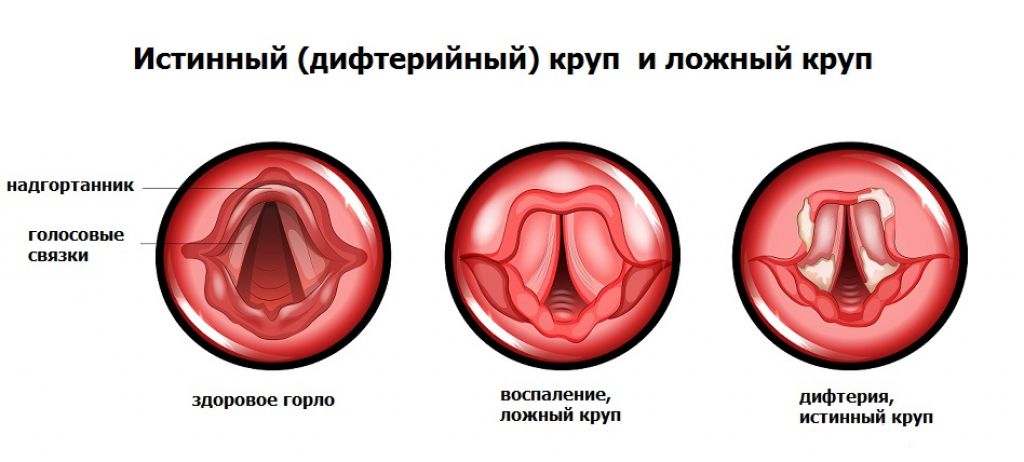 Острый обструктивный ларингит аускультативная картина