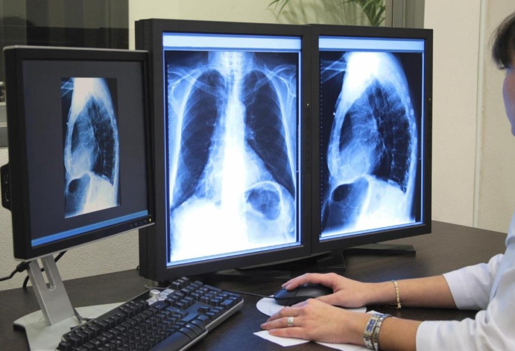 Рентген при туберкулёзе