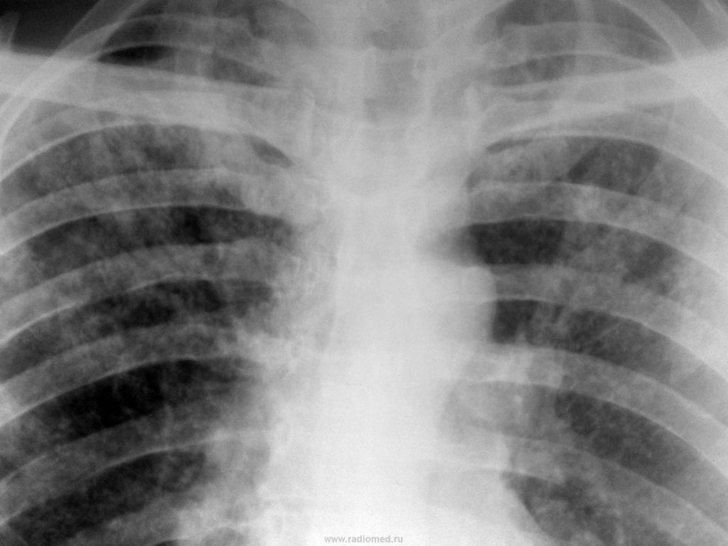 Туберкулёз на снимке