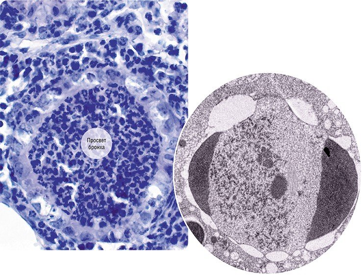Слева: Светооптический препарат легкого мыши, зараженной вирусом гриппа. Просветы двух мелких бронхов «забиты» разрушенными клетками и лейкоцитами, клетки эпителия повреждены. В окружающей бронхи ткани легкого – интенсивное воспаление. Справа: Апоптоз («самоубийство») ядра клетки, зараженной вирусом гриппа. На ультратонком срезе ядра клетки видны характерные «полулуния» конденсированного хроматина (остатки клеточной ДНК), в нуклеоплазме расположены вирусные структуры
