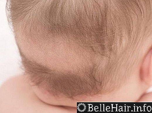 Выпадают волосы 4 месяц. Рахит облысение затылка. Облысение затылка у детей. Волосы у новорожденных на голове.