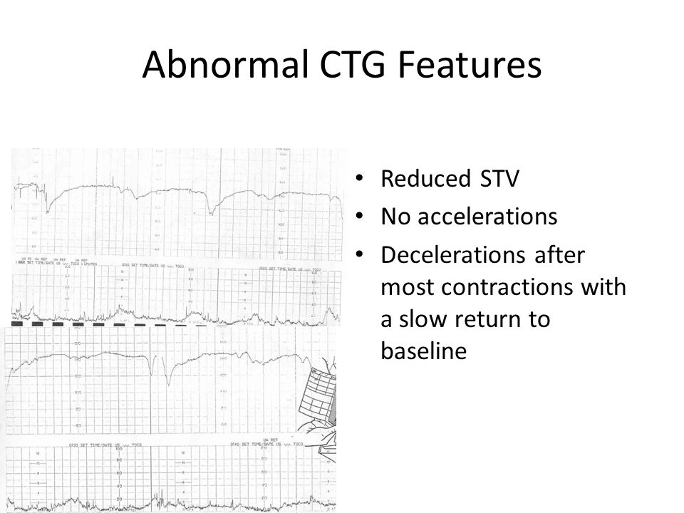 Abnormal CTG Features Reduced STV No accelerations