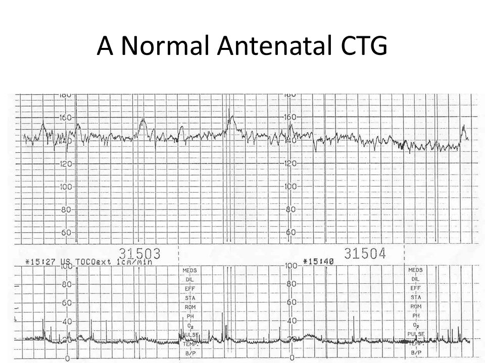 A Normal Antenatal CTG