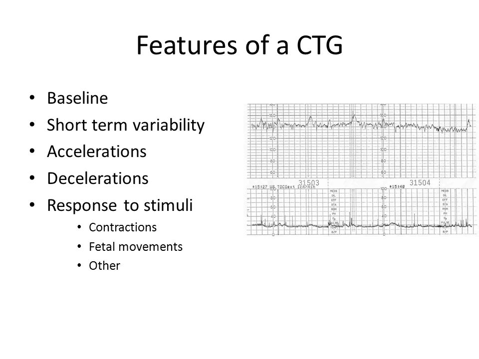 Features of a CTG Baseline Short term variability Accelerations