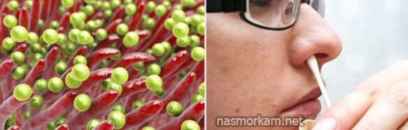 Как использовать Хлорофиллипт для лечения носа