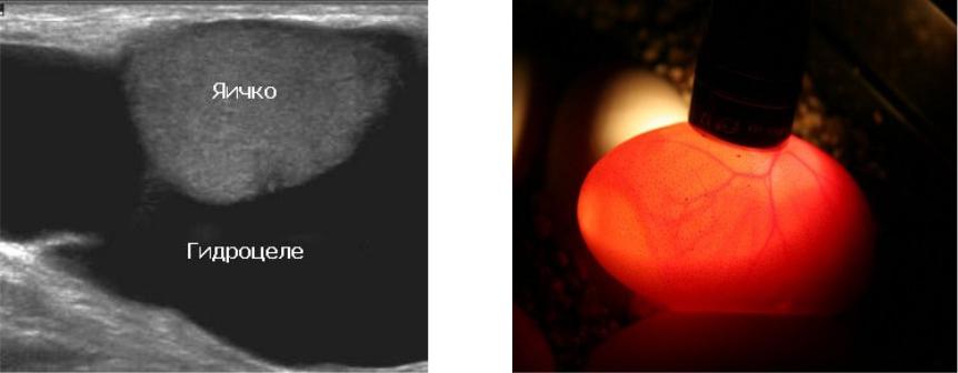 Презентация водянка яичка