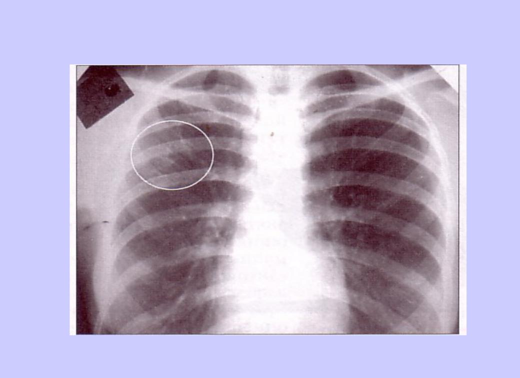 Туберкулез легкого рентгенограмма. Очаговый туберкулез рентген. Очаговый туберкулез рентген снимки. Внелегочный туберкулез рентген.
