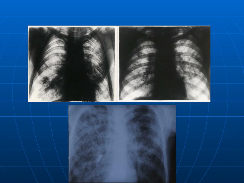 Лимфогенный туберкулез. Подострый диссиминированный туберкулёз рентген. Подострый диссеминированный туберкулез рентген. Лимфогенно диссеминированный туберкулез рентген. Подострый диссеминированный туберкулез кт.
