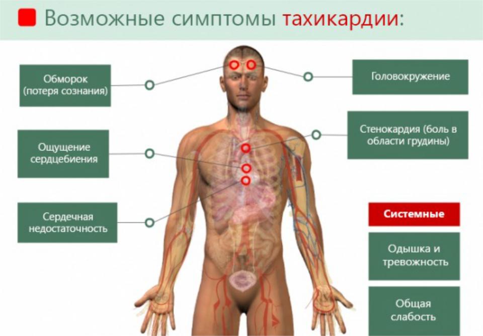 Ощущение бьющегося сердца. Тахикардические проявления. Симптомы при тахикардии. Симптомы учащенного сердцебиения. Признаки тахикардии сердца.