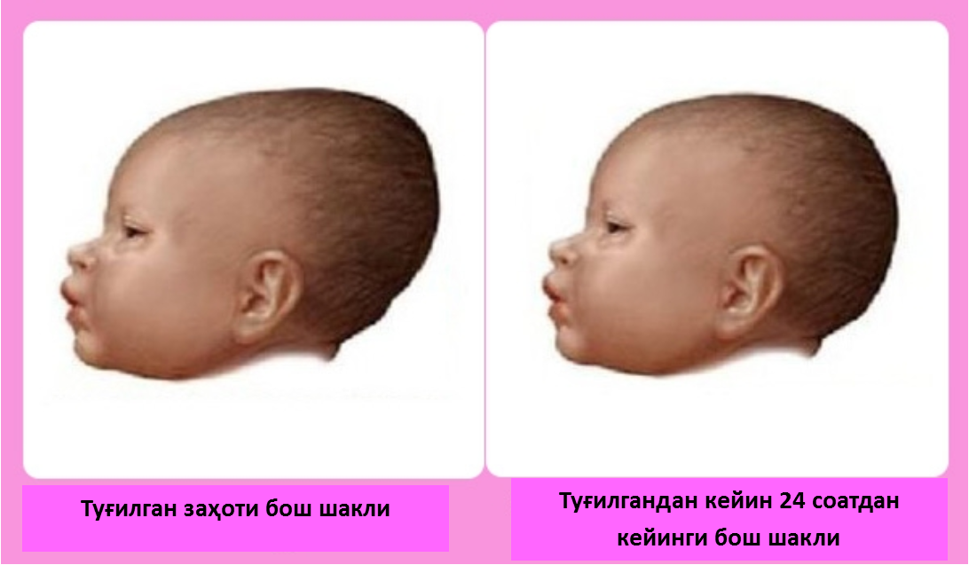 У ребенка пульсирует родничок. Форма головки новорожденного. Форма головы новорожденного. Форма головы у грудничка.