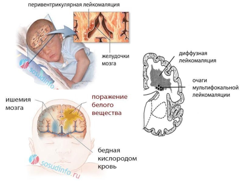 Церебральная ишемия. Ишемия головного мозга у новорожденного. Дети с кровоизлиянием в мозг родовая травма. Перивентрикулярная ишемия у новорожденного. Перивентрикулярные кровоизлияния.